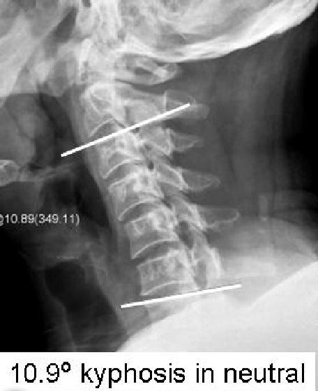 with kyphosis. Preoperative cervical spine lateral radiograph shows 10.