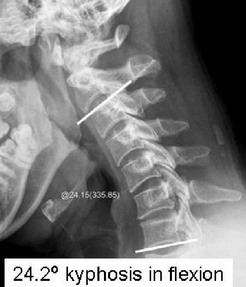 5 o kyphosis in extension (C). Preoperative MR image (D).