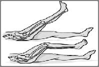 Foot inversion - Toes - - nerve bias common