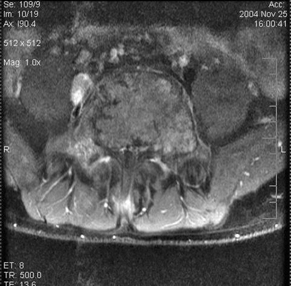 MRI in 43-year-old man with brown tumor of the spine. A. Sagittal T2-weighted image shows heterogeneous low signal mass of L5 body. B.