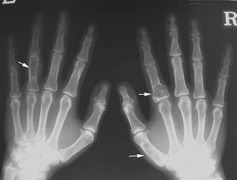 proximal phalangeal and right first metacarpal bone and proximal phalanx of second finger (arrows). Fig.