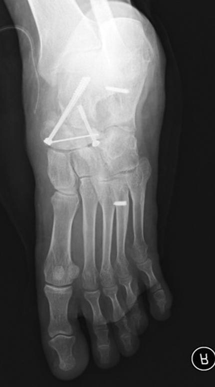 Preoperative simple radiographs of the foot anteroposterior () and lateral () show that 3rd to 5th metatarsal bone fractures, talar head and cuboid bone fractures were observed and