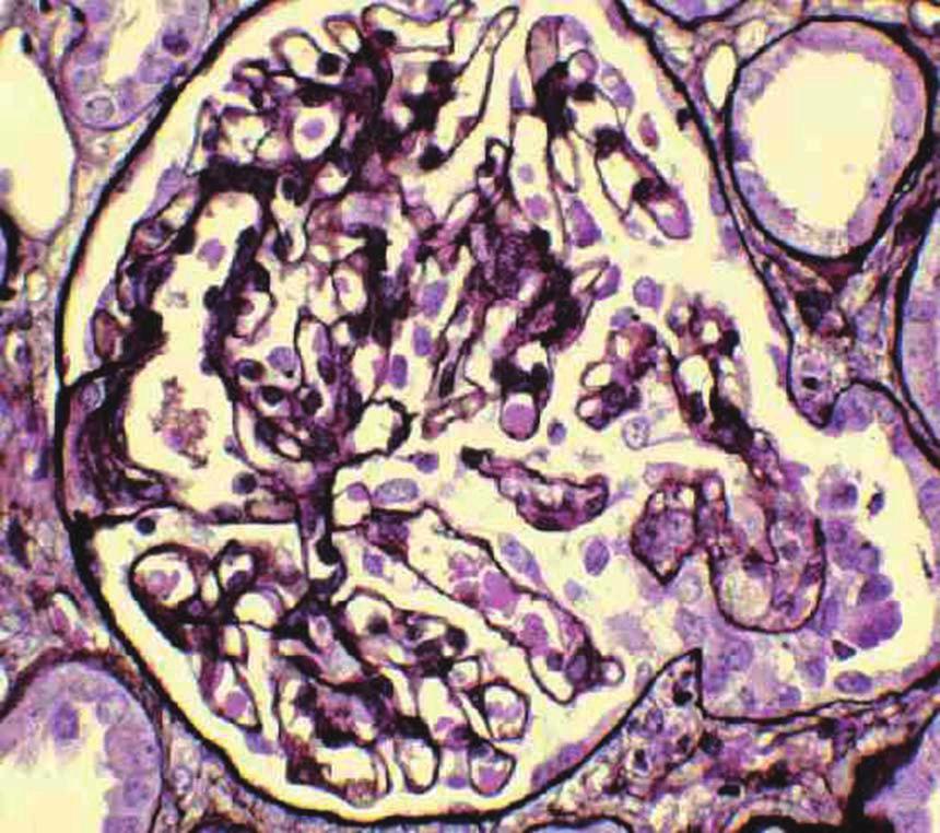 Kim YJ: Pathology and Classification of Focal Segmental Glomerulosclerosis 혈관의 일부가 탄력을 잃고 찌그러져서 막히는 현상으로 딱 딱하게 느껴지는 모습이 묘사되는 것이다. 동맥경화증의 경 화(硬化)와 같은 의미이다.