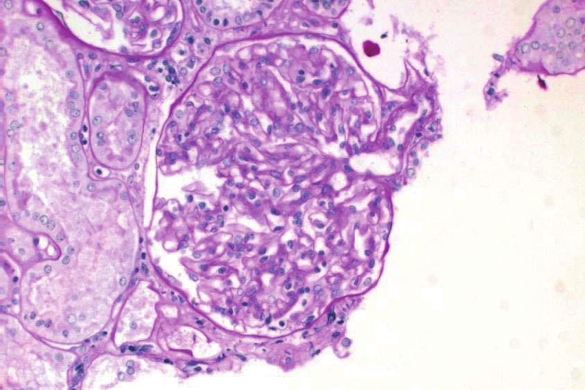 Segmental sclerosis (C) is followed and finally it becomes globally sclerotic (D). Fig. 6. Collapsing glomerulopathy.
