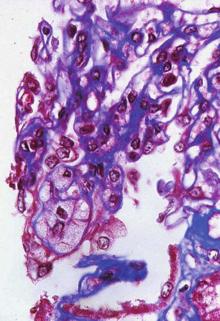 Kim YJ: Pathology and Classification of Focal Segmental Glomerulosclerosis 6. 혈관(Fig. 1, 4) 25 7. 면역형광현미경 소견(Fig.