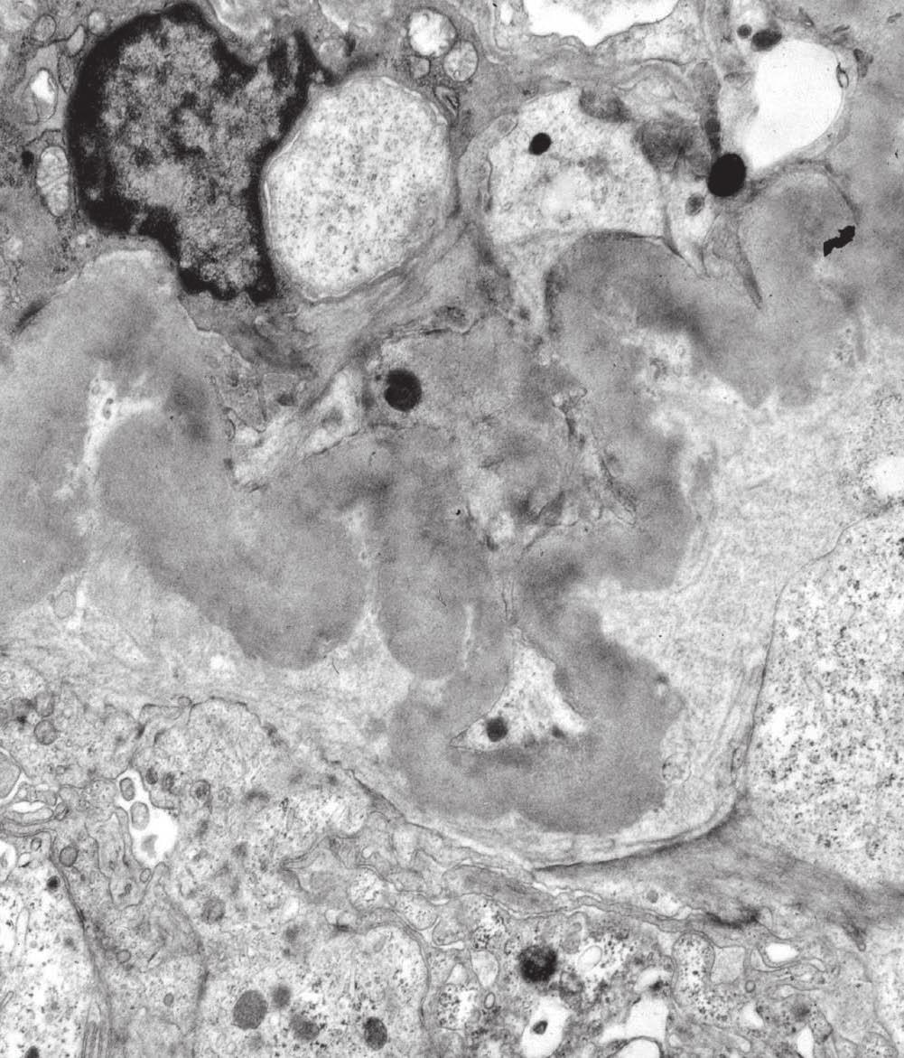 그 사이 간격은 새 로 생긴 것으로 여겨지는 가는 교원 섬유질로 채워져 있 다(Fig. 10). 이렇게 생긴 간격은 광학현미경에서는 특히 trichorme 염색에서 사구체 모세혈관 벽과 발세포 사이에 Fig. 9.