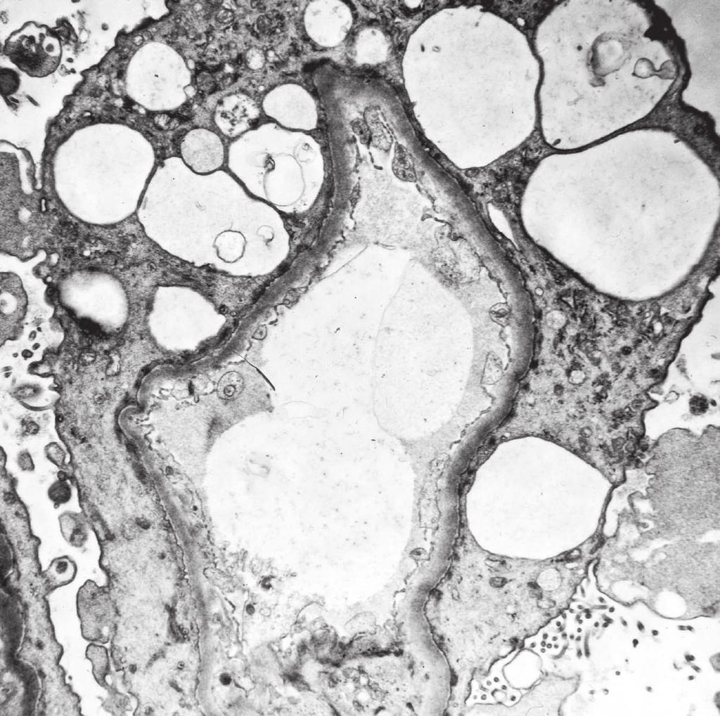 Kim YJ: Pathology and Classification of Focal Segmental Glomerulosclerosis 27 염색이연하게되는달무리 (halo, 光輪 ) 같은모습으로보인다. 경화가일어나지않은곳에는 minimal 에서보는족돌기 (foot process) 융합이있다.