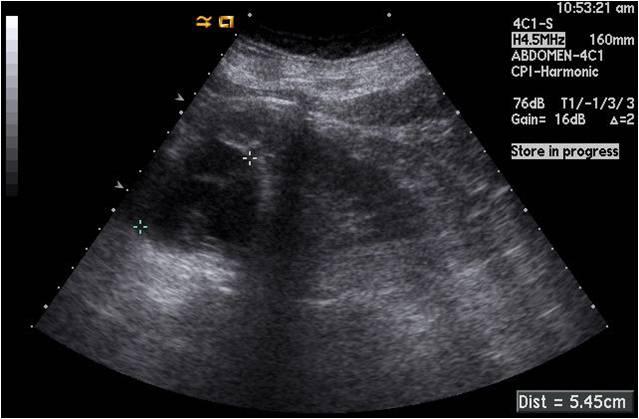 에서 단백뇨(-), 혈뇨<1/HPF, 백혈구<1/HPF로 특이소견 없었다. C D Figure 1. () Seven years ago, abdomen tomography revealed about 7 cm sized bulging thin walled cyst in the upper pole of the left kidney.