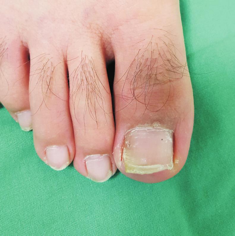 113 Yong-Woon Shin, et al. Gutter Splint for Ingrown Toe Nail in Young Patients A B C D 고 Table 1.