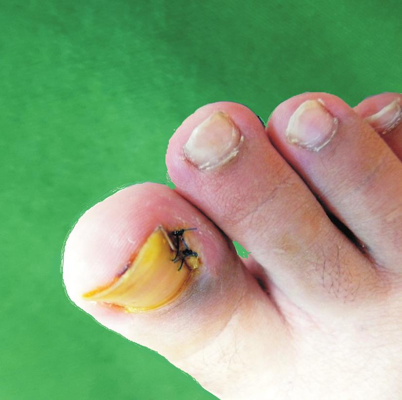 (A) Ingrown nail treated with gutter splint fixed by suture. (B) After healing there was a small puncture that may play as a stress riser and be easily broken.