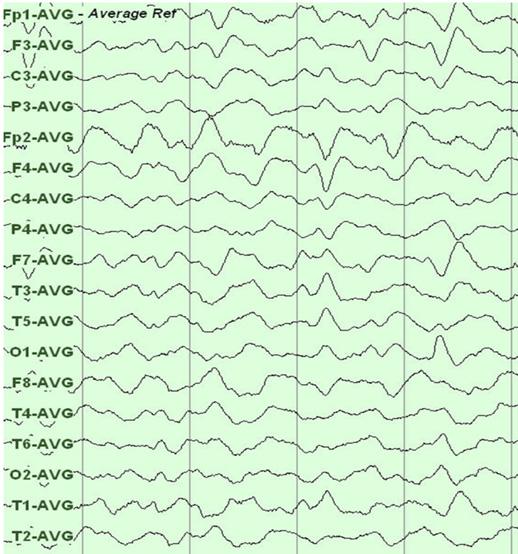 하였다. 입원 18일째활모양강직자세 (opisthotonic posture) 와피질제거경축 (decorticate rigidity) 이나타나뇌척수액검사를다시시행하였으며, 백혈구는 60개 /μl (48% 림프구 ), 단백질은 93.9 mg/dl 로감소하였고당수치도악화소견은없었다.