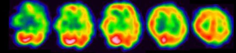 T1 axial brain MRIs at the age of 64 () and 65 () showed progression of diffuse cortical atrophy.