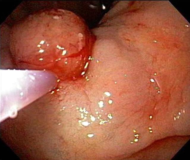 Hyuk Su Son, et al. A case of bleeding gastric villous adenoma Figure 3. Endoscopic removal.