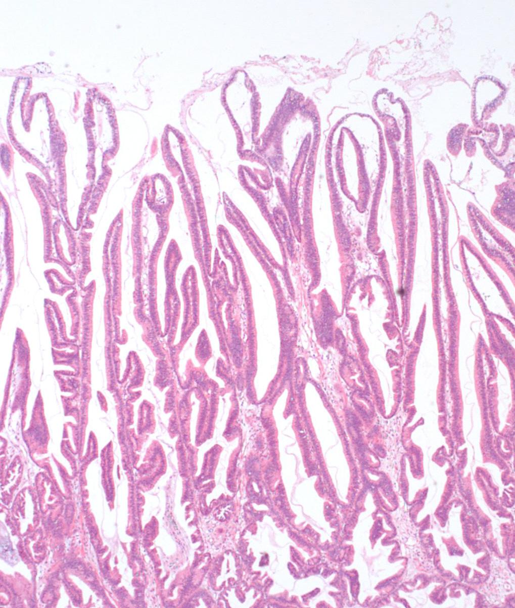 Long finger-like projections stretching with minimal branching covered by columnar epithelia (H&E stain, 40).