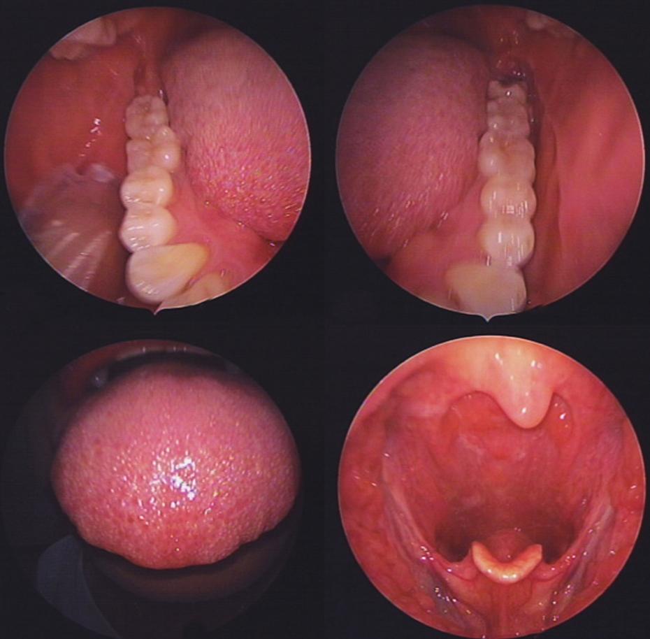 Korean J Otorhinolaryngol-Head Neck Surg 2013;56:550-6 군으로 나누는 것이다 에서 제시한 것처럼 속발성 구강 작열감 증후군은 다양한 구강점막상태 점막손상 궤양 구강 칸디다증 등 와 전신상태를 가진 환자에서 생기는 구강 작열 통증을 지칭하며 관련된 다양한 선행요인을 확인할 수 있고 이를 적절히 치료하면 증상 또한