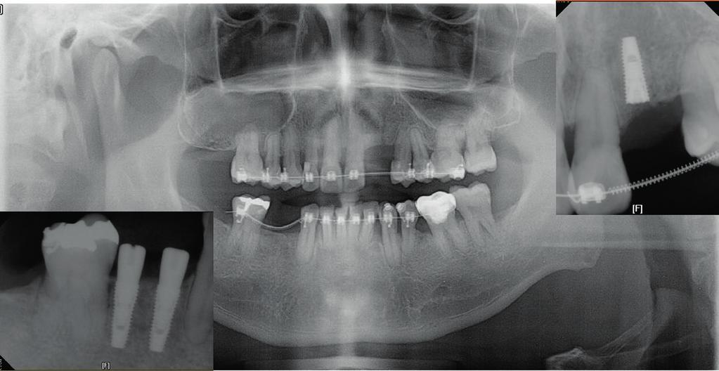 JOURNAL OF KOREAN ACADEMY OF ADVANCED GENERAL DENTISTRY Figure 6. POD 52 weeks : Rotation control (Mx. and Mn. : 16 S-S). Figure 7. Implant place on #22, 44, 45.