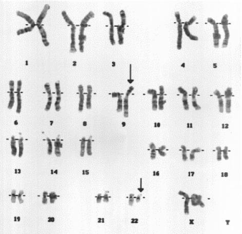 병태생리 1960 년 : 만성골수백혈병 (CML) 환자의백혈구에서비정상적으로짧아진염색체발견 -> 22 번염색체