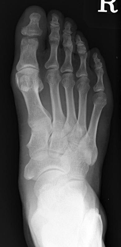 the interphalangeal joint of the great toe. Figure 4.