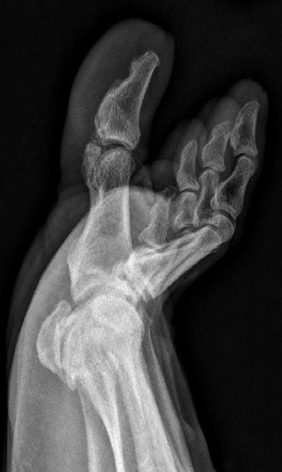 428 김재광 김락규 Figure 6. Radiographs taken at 4 years after surgery show maintained reduction state of the interphalangeal joint of the great toe. 고찰 Miki 등 4) 은족무지지간관절의탈구에대해두가지유형으로분류하였다.