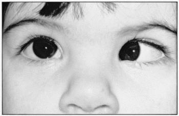 } Refractive errors } 근시, 원시, 난시 } Binocular dysfunction Strabismus (Crossed or wandering eye) : 근육의불균형으 로인함 Double vision Effects