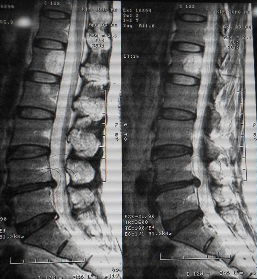 추나치료를병행한돌출형요추추간판탈출증환자의영상의학적변화 1 례 Fig 2. L-spine MRI, SAG(05-4-12).