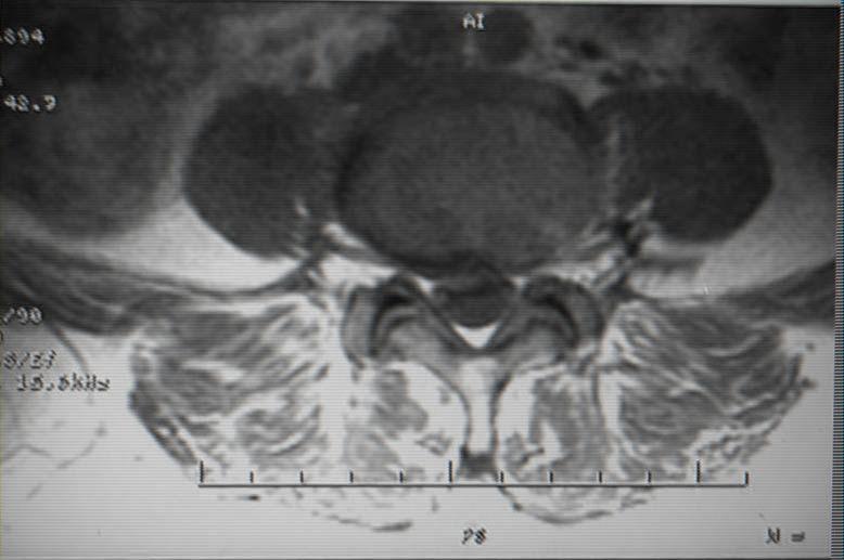 Fig 5. L-spine MRI, AXL(06-2-23). Ⅲ.