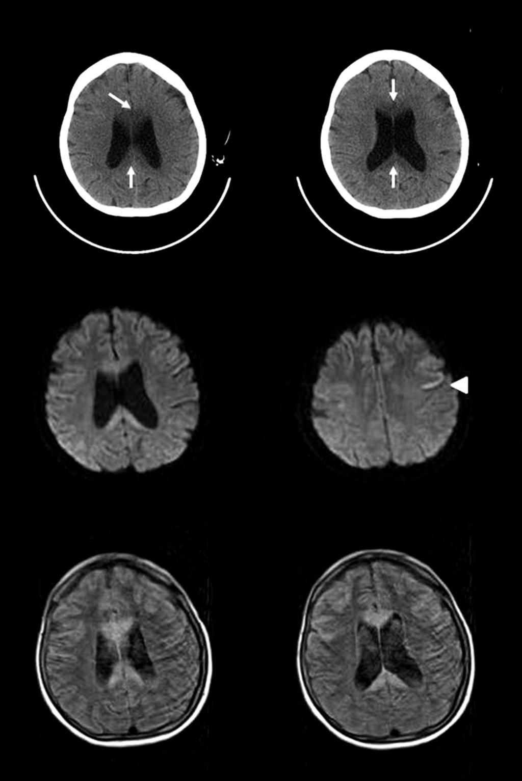 하는혼동 (confusion), 구음장애, 사지위약을주소로응급실에내원하였다. 환자는약 6년전부터하루에소주 2-3병정도를매일마시는만성알코올중독자 (alcoholic) 였으며, 평소식사를제대로하지않았다. 수차례알코올전문병원에서입원치료를받았으며다른특이병력은없었다.