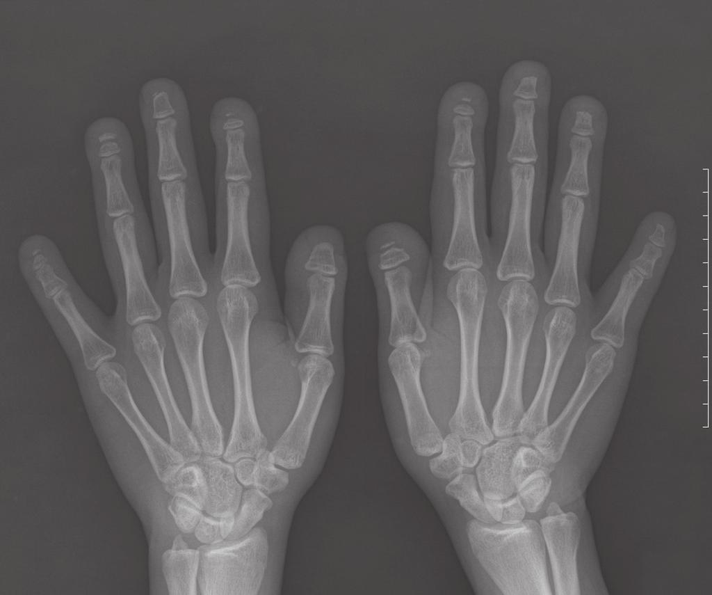 of the tuft to loss of almost entire distal phalanges.