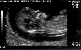 11-13 주태령을갖는임신전기검사의중요인자로작용 Lyn Chitty 2001,
