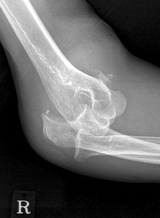 showed fracture of the radial head, coronoid process and elbow