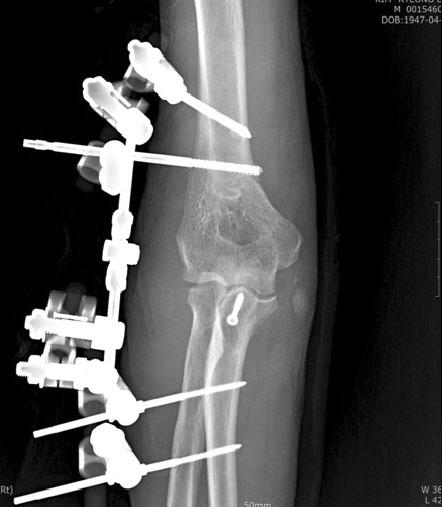 hinged external fixation for elbow instability.