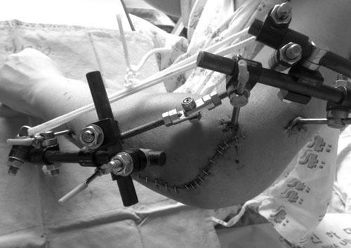 (A) Postoperative photo with hinged external fixator.
