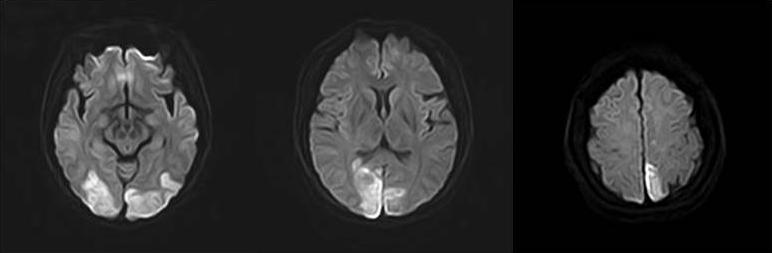 A C B Figure 8. MRI of reversible cerebral vasoconstriction syndrome.