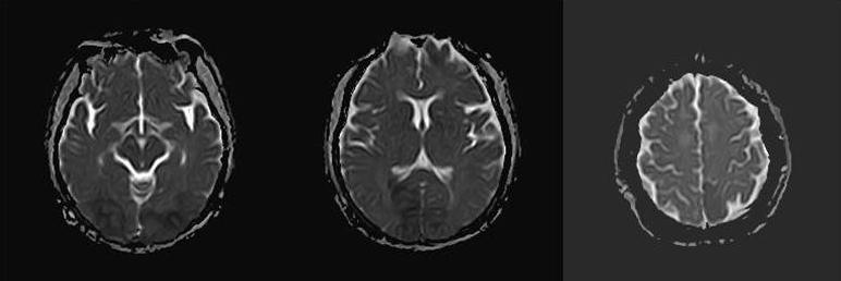 DWI (A) and ADC maps (B) demonstrate cytotoxic edema, consistent with infarcts, in the bilateral parieto-occipital regions.