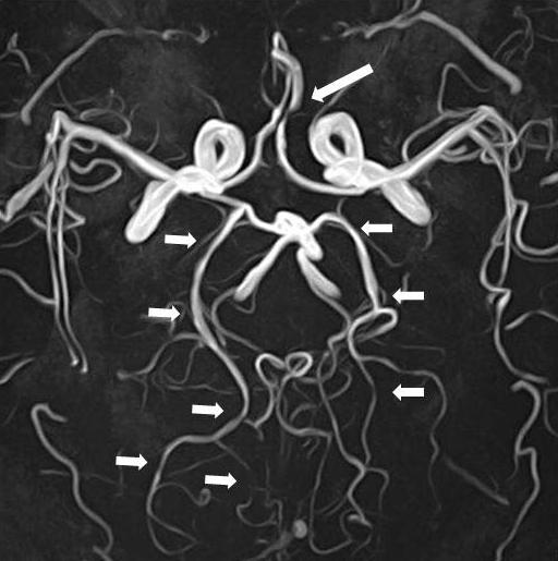 cerebral arteries (short arrows).