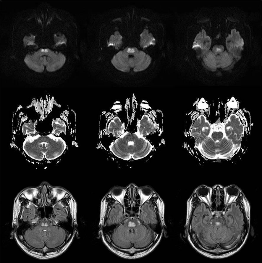 MRI; magnetic resonance imaging, DWI; diffusion weighted images, ADC; apparent diffusion coefficient, FLAIR; fluid attenuation inversion-recovery, MRA;