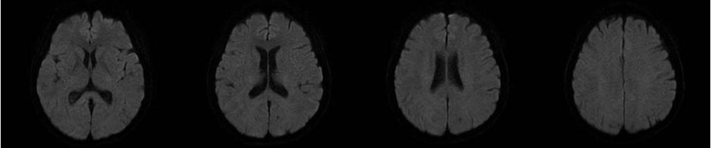 A B C D Figure 2. Typical Parietal-occipital pattern of PRES.