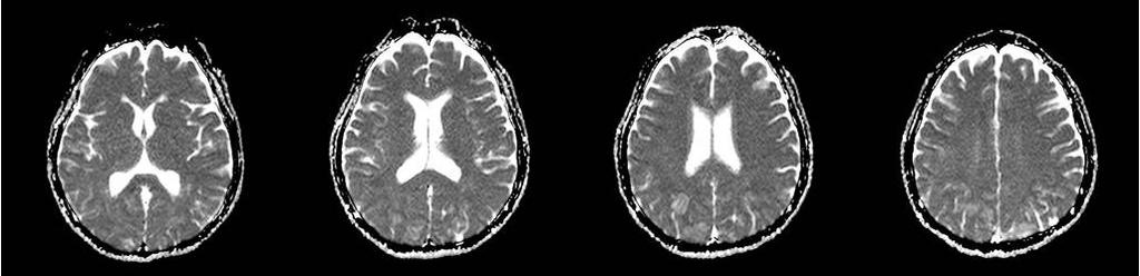 There is slight leptomeningeal enhancement in the posterior area (D).