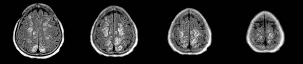 Figure 3. Superior frontal sulcus pattern of PRES.