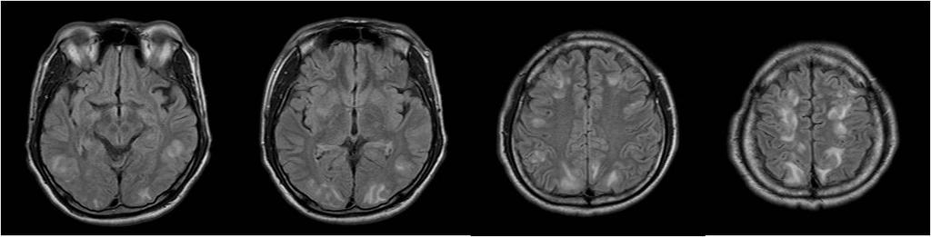 superior frontal sulci. PRES; posterior reversible encephalopathy syndrome, FLAIR; fluid attenuation inversion-recovery. Figure 4. Holohemispheric pattern of PRES.