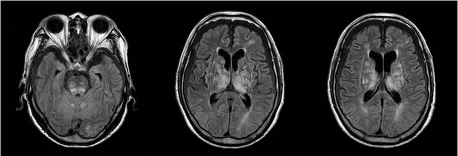 A B C Figure 5. Central-variant pattern of PRES. A 80-year-old man presented with altered mental status, acute pyelonephritis, and recent history of mild head trauma.