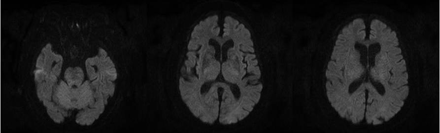 Follow-up FLAIR imaging (C) at 7 days later shows almost resolution of the vasogenic edema and altered mental status of the patient recovered completely within 10 days.