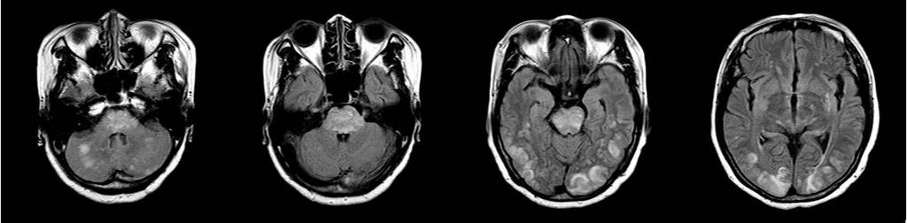 A B C Figure 6. Severe PRES. A 58-year-old woman, suffered from systemic lupus erythematosus, presented with seizures.