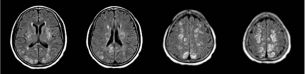 There is also vasogenic edema in the bilateral pons, basal ganglia, and cerebellar hemispheres. On a follow-up FLAIR imaging (C) performed 1 week later, most of the previous lesions were resolved.