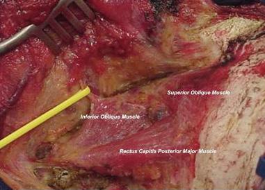 Fig. 2 및수술적접근법, 절제정도를조사하였다. Suboccipital triangle exposure. Fig. 3 Occipital condyle and jugular process. After the suboccipital craniotomy, atlantooccipital joint and jugular process can be exposed.