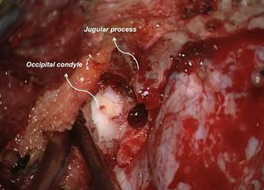 Surgical Procedure 수술적접근법은 6례에서극외측접근법 (far lateral approach), 2례에서후외측접근법 (posterolateral approach) 이시도되었으며, 나머지 6례에서타과와공동으로복합접근법 (combined approach) 이시도되었다 (Table 1).