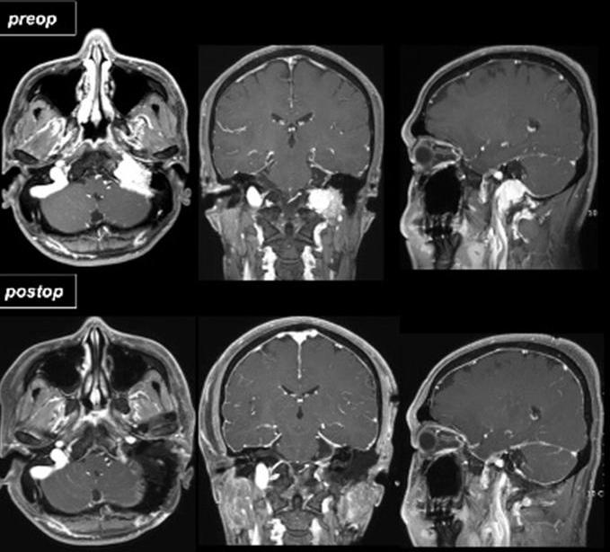 (hypoglossal nerve) 을노출시키게되고내경정맥의원위부를확보하여필요시결찰할수있도록하였다. 4) Combined approach 상기접근법만으로종양의충분한노출이부족한경우이과의사 (otologist) 의도움을받아복합접근법을시행하였다.