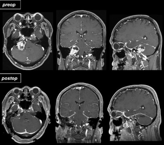 schwannoma) 이진단되었다 (Fig. 7). 후외측접근법을통하여종양제거를시도하였으며종양은전절제가되었다. 수술후하우스- 브랙만등급 IV의안면마비가발생하였지만, 수술 6개월후하우스-브랙만등급 II로호전되었다. DISCUSSION 경정맥공종양의분류는각각의병리 ( 신경초종, 곁신경절종, 수막종 ) 에대해다른분류법이존재한다.