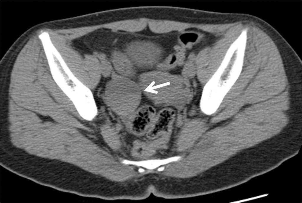 청소년기의급성부인과계질환 Fig. 1. Hemorrhagic ovarian cyst in a 13-year-old girl who complained of abdominal pain in right lower quadrant area for one day.