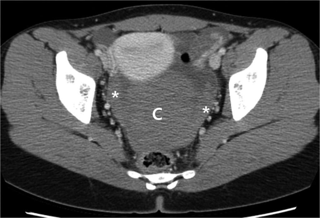 Precontrast axial scan shows a high attenuation cystic mass (C) in pelvic cavity. lso note high attenuation fluid collection in pelvic cavity (*), suggesting hemoperitoneum.